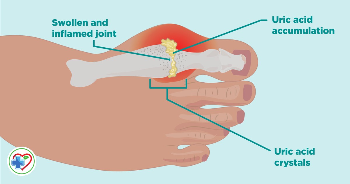 Why You Shouldn’t Ignore Gout